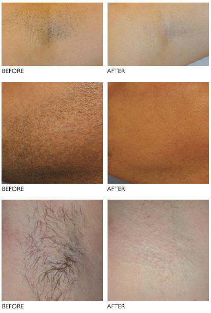 LASER HAIR REMOVAL Art Esthetic Tartu